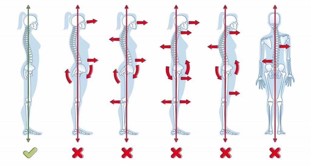 Hohlkreuz? Mache DAS für eine geradere Haltung (Hyperlordose