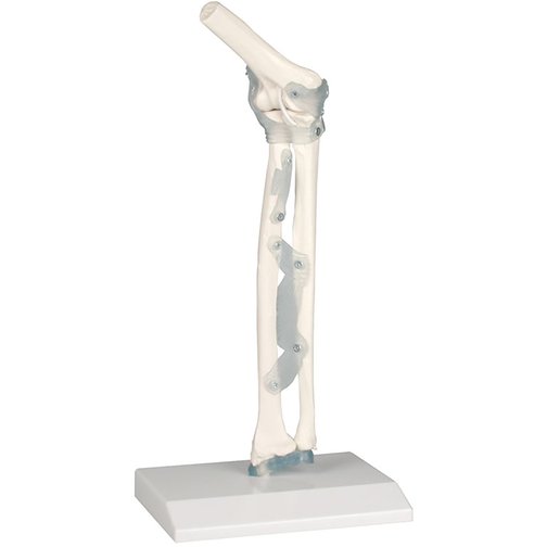 Erler-Zimmer Ellenbogengelenk mit Bänder
