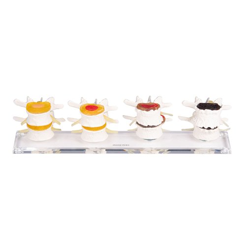 Erler-Zimmer Stadien der Bandscheibenschädigung